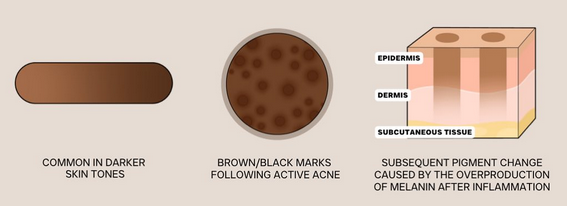 how melanin-rich skin produces hyperpigmentation after inflammation