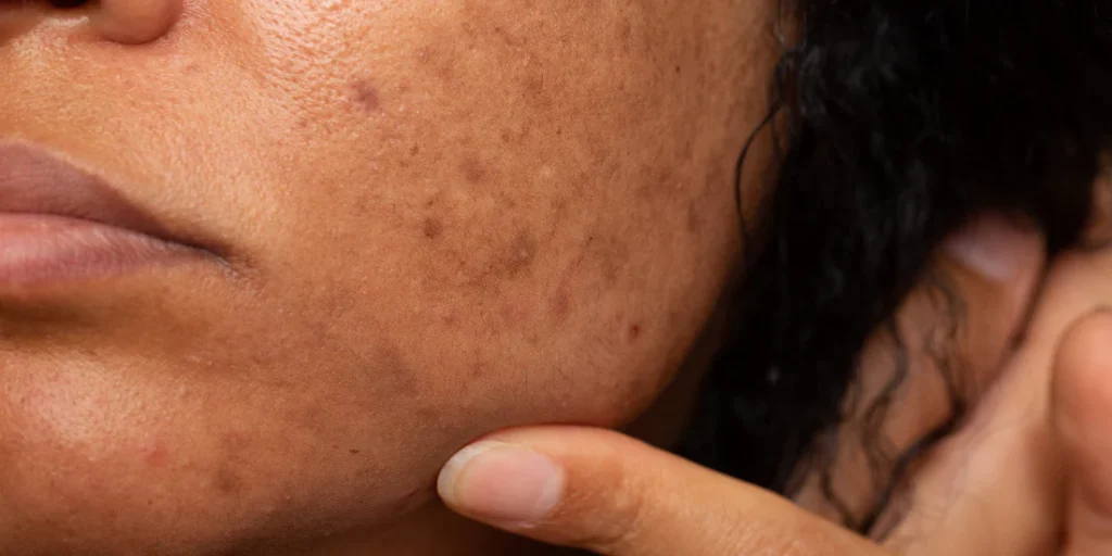 common causes of hyperpigmentation on dark skin